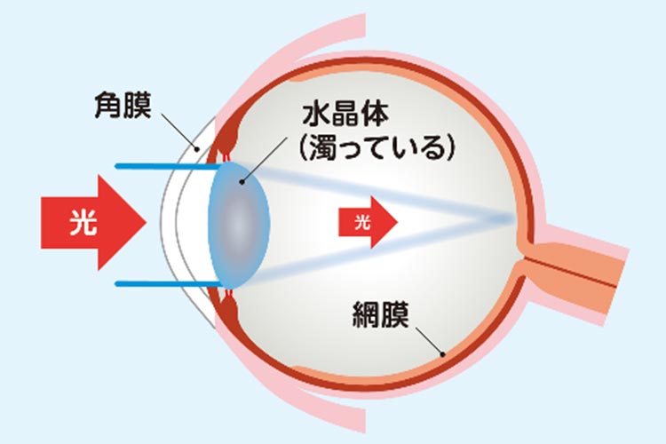 白内障画像