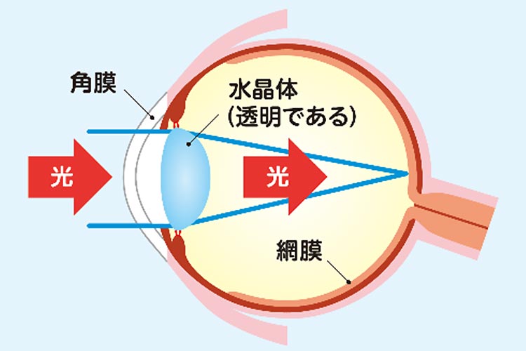 白内障画像