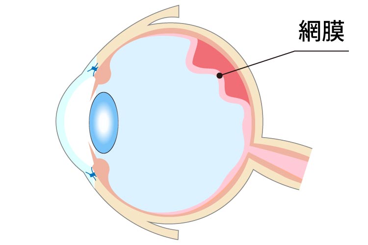 網膜剥離画像