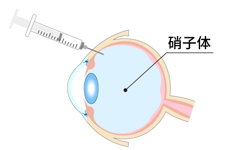 硝子体注射画像